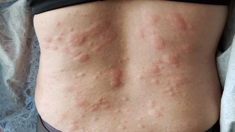 Itchy Bumps on Back – A Symptom of a More Serious Disease? a Look